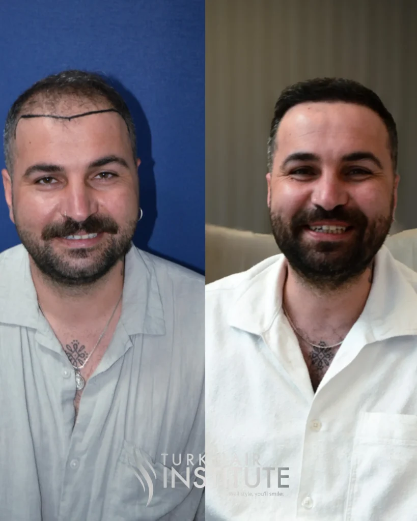 FUE ve DHI Arasındaki Farklar: Hangi Yöntem Sizin İçin Daha Uygun? 1 FUE ve DHI Arasındaki Farklar: Hangi Yöntem Sizin İçin Daha Uygun?